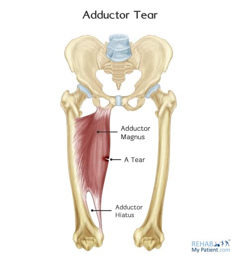 Adductor Tear | Rehab My Patient