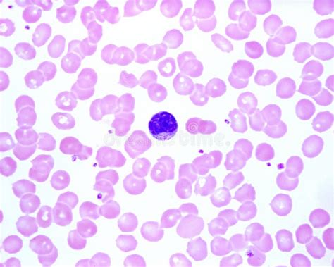 Human Blood Smear. Monocyte Stock Photo - Image of monocyte ...