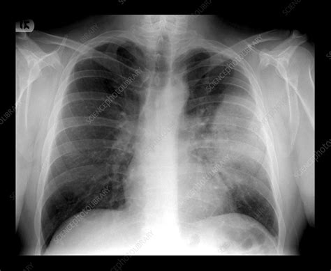 Lobar Pneumonia on Chest X-ray - Stock Image - M240/0753 - Science ...