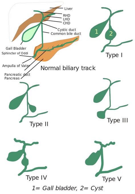 Choledochal cyst types, causes, symptoms, diagnosis & treatment