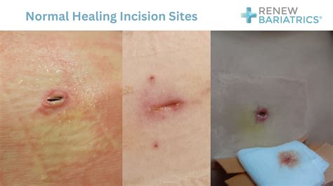 Incision Care after Bariatric Surgery | Photos | Healing & Recovery