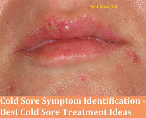 Cold Sore Symptom Identification - Best Cold Sore Treatment Ideas ...