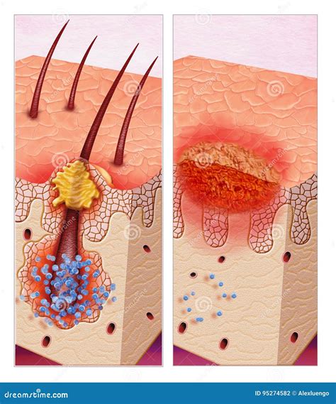 Pustula or Folliculitis stock illustration. Illustration of ...