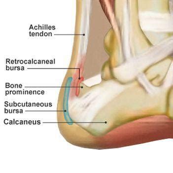 Physio ScienceUK: Insertional Achilles Tendinopathy