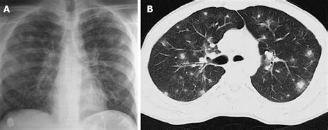 Imaging evaluation of hemoptysis in children