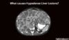 What Causes Hypodense Lesions in the Liver? Liver Mass Differential Diagnosis