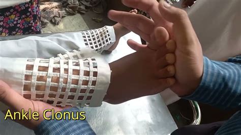 Clonus || ankle clonus in real patient || how to check clonus - YouTube