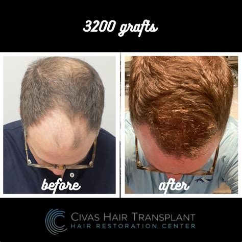 Dr ekrem civas, 3200 grafts, fue | Hair loss Forum - Hair Transplant forums