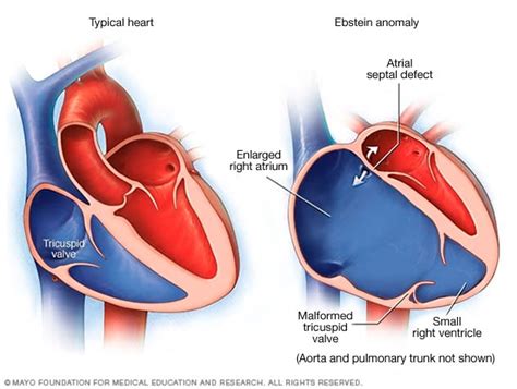 Tricuspid valve regurgitation - Symptoms and causes - Mayo Clinic