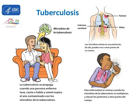 Tuberculosis ¿Qué es y cuáles son sus síntomas? - Fundación Hospital Infantil Napoleón Franco ...