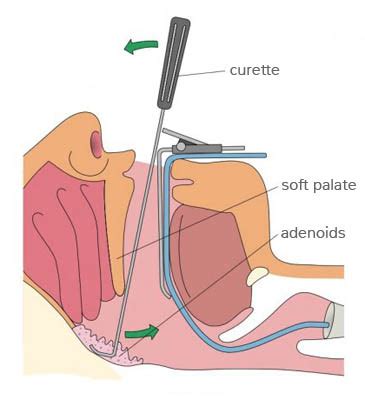 Adenoidectomy — ent4kids