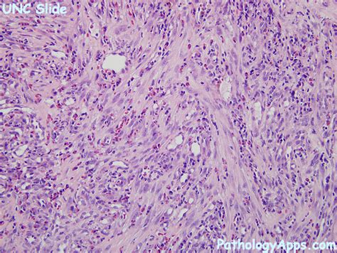 granulation tissue histology