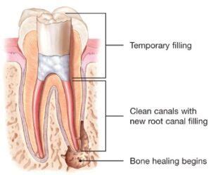 Root Canal Retreatment - Best Endodontics