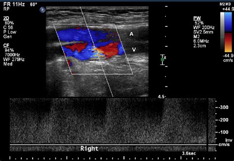 Femoral Av Fistula Ultrasound