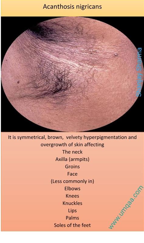 What are the causes of Acanthosis nigricans? | Acanthosis nigricans ...