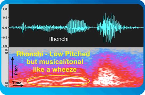 rhonchi | Lung sounds, Breath sounds, Hearing