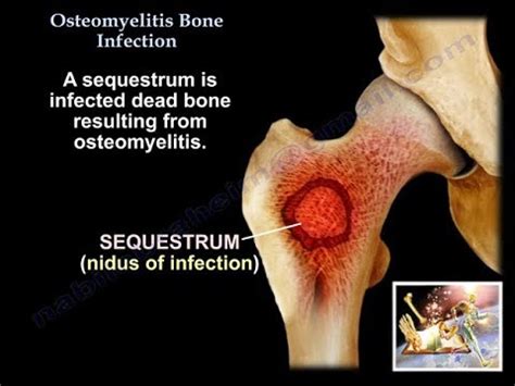 Jaw Bone Infection Symptoms And Osteomyelitis Causes