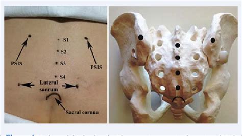 Ultrasound Sacroiliac Joint Injection