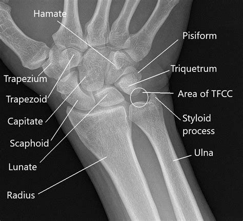 Causes and Management of Wrist Joint Pain - Complete Orthopedics