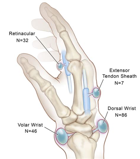 Review of Ganglion Cysts - Sports Medicine Review