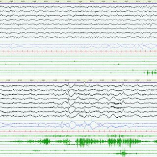 Examples (30s) from nocturnal polysomnographies showing REM sleep with... | Download Scientific ...