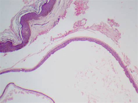 Steatocystoma 1 | Partly collapsed cyst is located beneath t… | Flickr