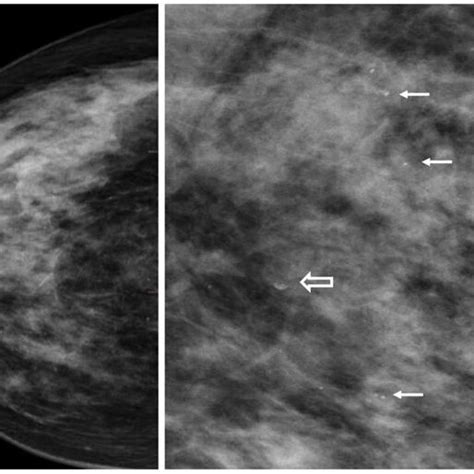 5a & 5b X ray mammogram showing dense fibroglandular pattern ACR Type... | Download Scientific ...