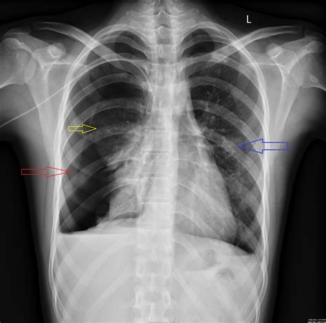 Cureus | Simultaneous Bilateral Spontaneous Pneumothorax: A Rare Complication of Osteosarcoma