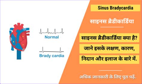 साइनस ब्रैडीकार्डिया - Sinus Bradycardia in Hindi, Symptoms, Causes