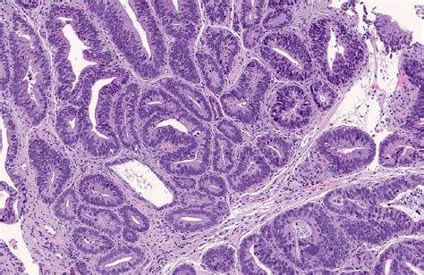 Gastric Adenocarcinoma Histology