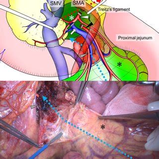 Wide Kocher maneuver. After mobilization of the duodenum and colon, the... | Download Scientific ...