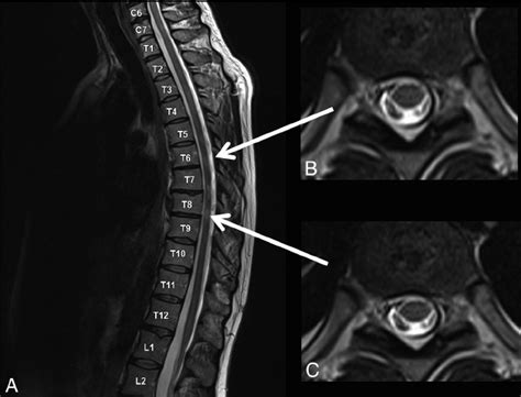 Examples of spinal cord lesions detected only on sagittal scans ( A )... | Download Scientific ...