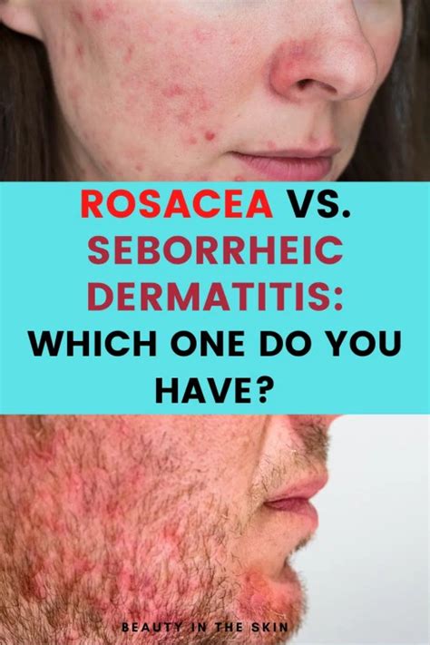 Rosacea vs. Seborrheic Dermatitis: How to Tell the Difference? - BEAUTY ...