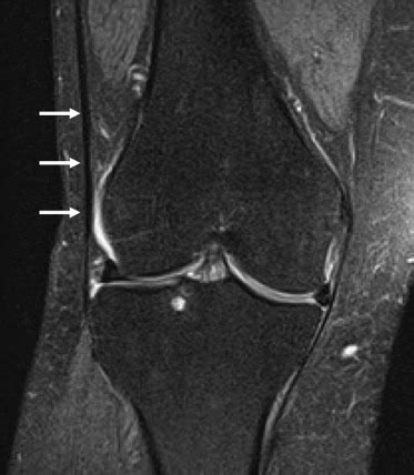 View 12 Knee Capsule Mri - belterespics