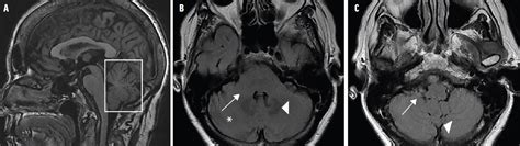 Adult-Onset Cerebellar Ataxias - Practical Neurology