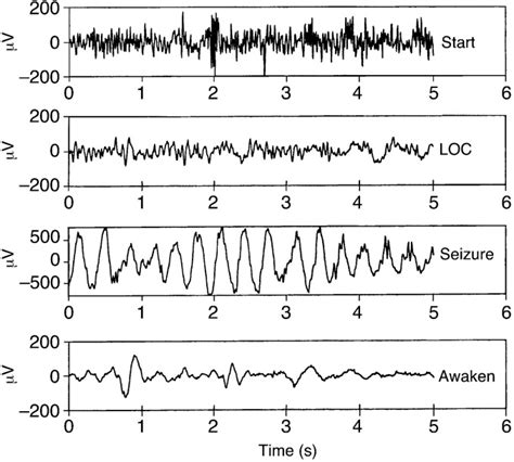 Bispectral index monitoring during electroconvulsive therapy under propofol anaesthesia ...