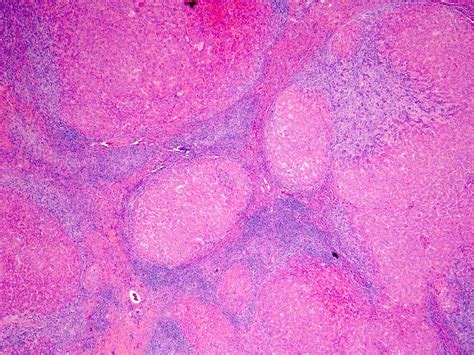 Nodular Regenerative Hyperplasia