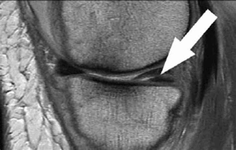 Injections for Meniscal (Cartilage) Tear | Steroid Injections For Meniscal (Cartilage) Tear ...