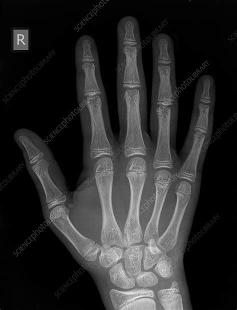 Metacarpal fracture, X-ray - Stock Image - C056/4177 - Science Photo Library