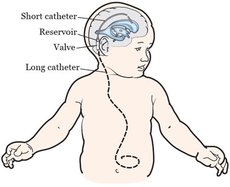 About Your Ventriculoperitoneal (VP) Shunt Surgery for Pediatric Patients | Memorial Sloan ...