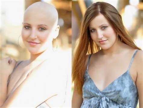 Wigs for Cancer Patients in Delhi India | Men Women Chemotherapy Wigs