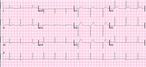 Dr. Smith's ECG Blog: Subtle LAD Occlusion with Pseudonormalization of Wellens' Waves.