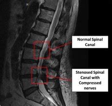 Lumbar Stenosis Diagnosis