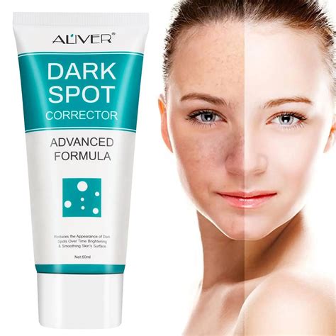 Whitening Freckles Cream Remove Melasma Dark Spots Lighten Melanin ...