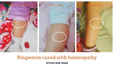 Ringworm treatment - Gentle Healing Homeopathy Dublin 15 and Online