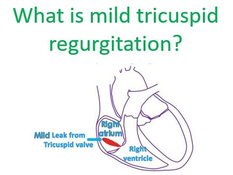 What is mild tricuspid regurgitation? - All About Heart And Blood Vessels