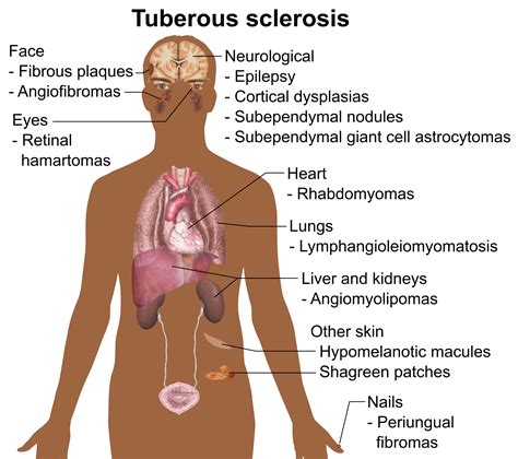 Tuberous sclerosis - Wikiwand