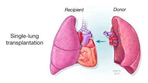 A lung transplant is a procedure to replace an infected or failing lung ...