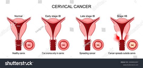 Cervical Cancer. Stages of a Carcinoma of Cervix - Royalty Free Stock Vector 2269002497 - Avopix.com