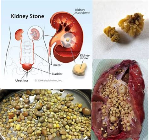 Strong and Beyond: How to Flush Kidney Stones Naturally With Just Four ...